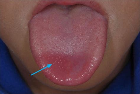 Transient lingual papillitis or lie bumps causes and lie bumps treatment