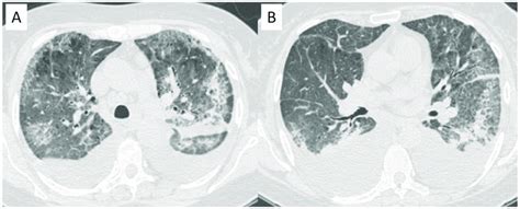 Cryoglobulinemic vasculitis in a patient with chronic renal failure and... | Download Scientific ...