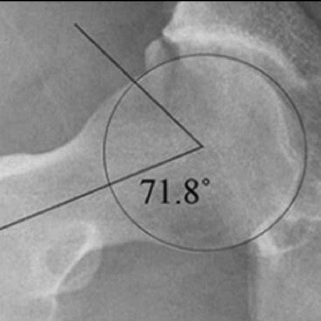 Hip Goniometry in 90 degrees fl exion (A. Hip in a neutral position and ...