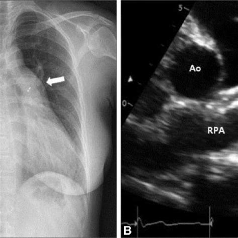 One day after the procedure, the embolized Amplatzer device (AGA... | Download Scientific Diagram