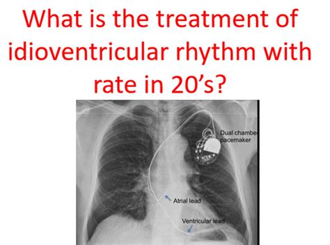 What is the treatment of idioventricular rhythm with rate in 20's? - All About Heart And Blood ...