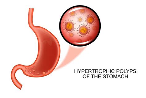 Stomach Polyps: Symptoms, Causes, Diet, Treatment | STD.GOV Blog