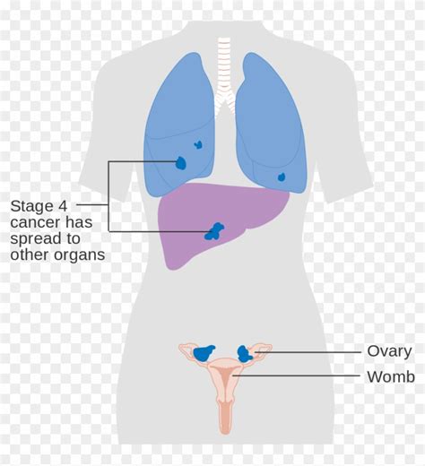 Diagram Showing Stage 4 Ovarian Cancer Cruk - Stage 4 Ovarian Cancer Criteria, HD Png Download ...