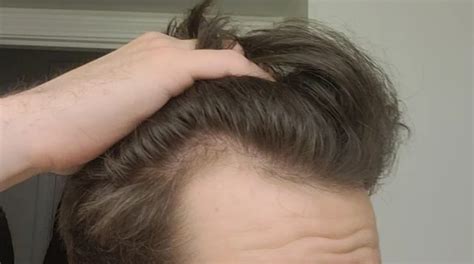 What Is A Mature Hairline And Can You Fix It? (With Pictures!)