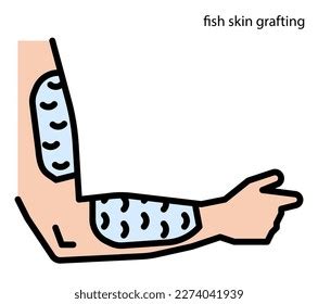 Fish Skin Grafting Wound Healing Stock Vector (Royalty Free) 2274041939 | Shutterstock