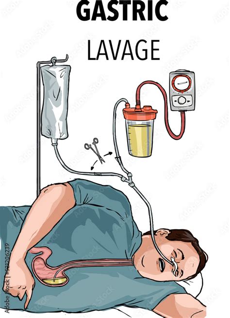 Gastric lavage with a gastric tube Stock Vector | Adobe Stock