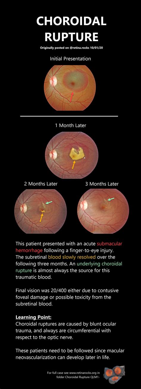 Trauma > Choroidal Rupture - Retina Rocks