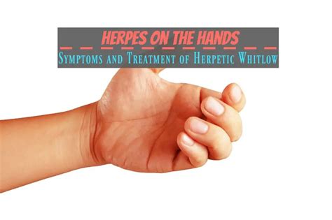 Herpes on the Hands: Symptoms and Treatment of Herpetic Whitlow - The Healthy Apron