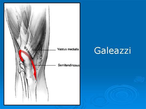 Surgical Treatment Of Habitual Dislocation Of The Patella