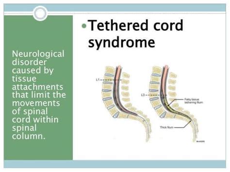 New Findings: Impact of Spinal Cord Tethering Depends on Age and SCI ...