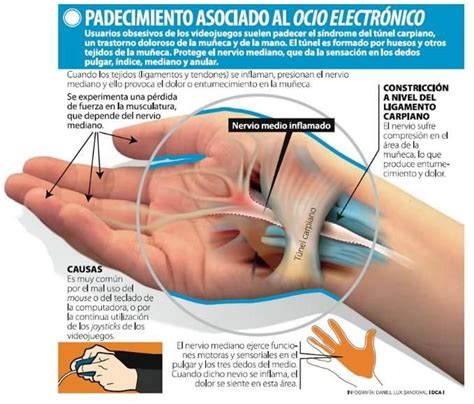 Síndrome del túnel carpiano. Síntomas y tratamiento