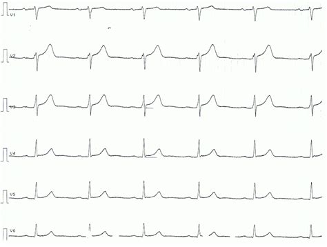 Pericarditis, myocarditis & perimyocarditis: ECG, criteria & treatment – ECG learning