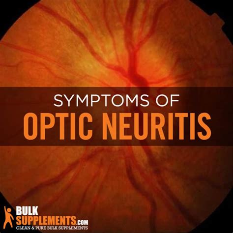 Optic Neuritis: Symptoms, Causes & Treatment