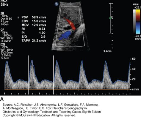 Uterine Artery Doppler Chart