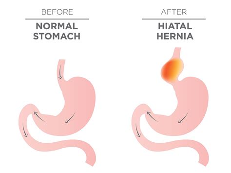 A/Prof Jaber | Hiatus Hernia Repair