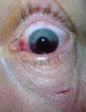 Traumatic hyphema - WikEM