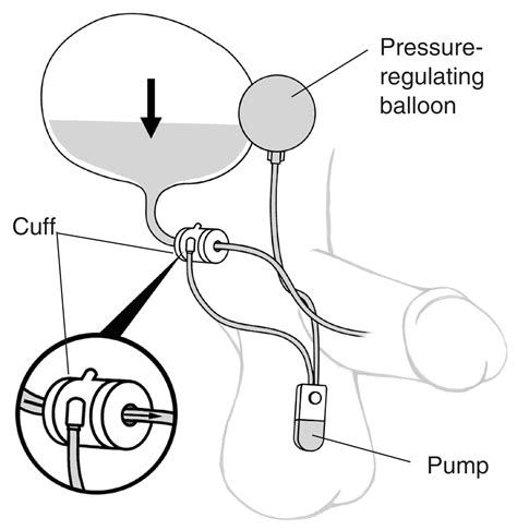 An artificial sphincter to treat male urinary incontinence with labels ...