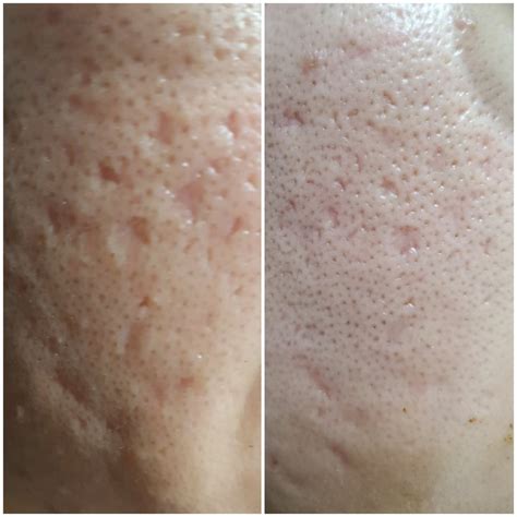 Improvement in pitted scars (Tretinoin, AHA30) : r/tretinoin