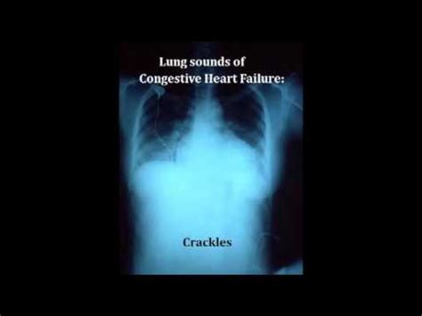 lung sounds - crackles - YouTube