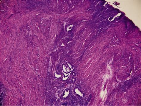 Histopathology of the adenomyoma. Admixture of endometrial-like glands,... | Download Scientific ...