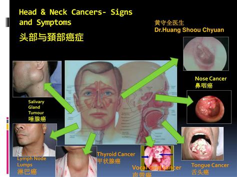 Head And Neck Cancer Diagram