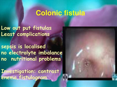 PPT - GI FISTULAS PowerPoint Presentation, free download - ID:9561148