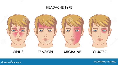 Headache types stock vector. Illustration of pain, artistic - 275850386