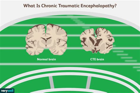 Co to jest przewlekła encefalopatia pourazowa? - Medycyna