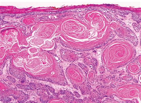 Invasive Squamous Cell Carcinoma Skin Cancer