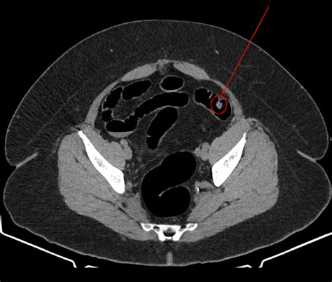 Colorectal Cancer Screening Options - University Diagnostic Medical Imaging