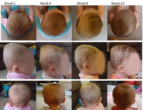 My Twins and Their Plagiocephaly Helmet Story | Plagiocephaly helmets, Baby head shape, Baby helmet