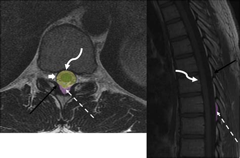 Frontiers | Imaging of metastatic epidural spinal cord compression