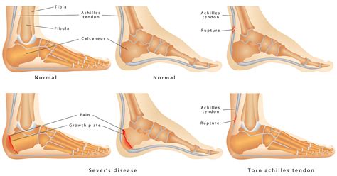 Functional Outcome of Acute Achilles Tendon Rupture +/- Operative Treatment Using Functional ...