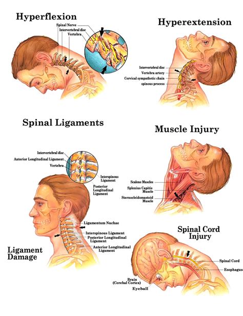 Whiplash Injury On Nerves