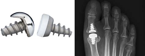 Joint Replacement - Minimally Invasive Bunion Surgeon