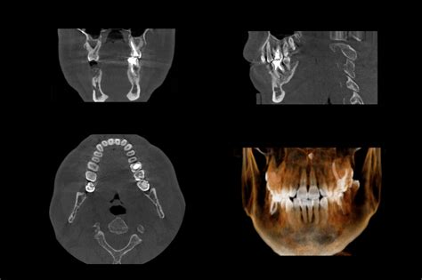 3-D Imaging (CBCT) - Compassion Endodontics