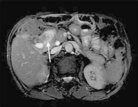 Axial T2W image revealing cholecystoduodenal fistula (marked with... | Download Scientific Diagram