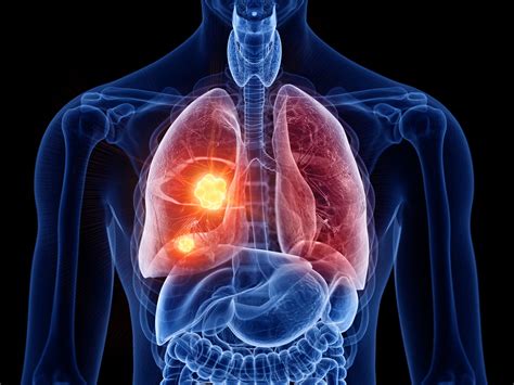 Perioperative Toripalimab With Chemo Improves EFS in Resectable Stage III NSCLC