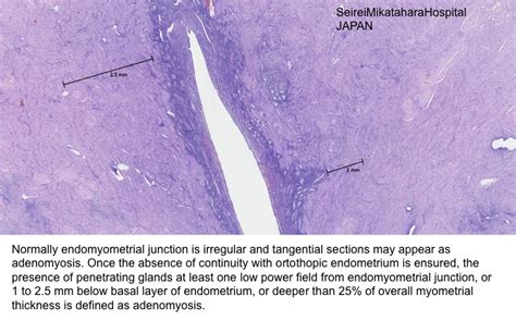 Pathology Outlines - Adenomyosis / adenomyoma