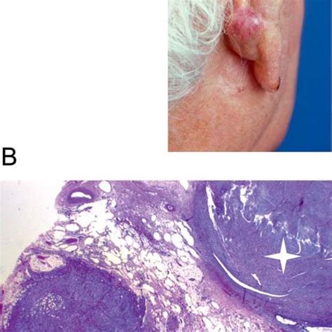 Atypical fibroxanthoma-specific survival according to Kaplan–Meier... | Download Scientific Diagram