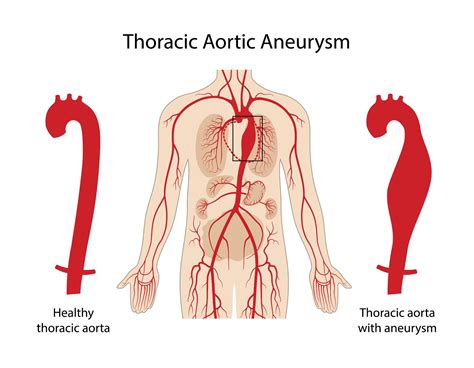 Thoracic Aneurysm & Dissection | UWMTAP