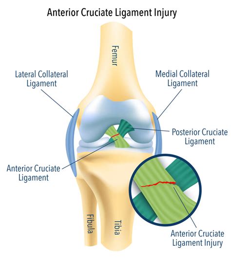 ACL Knee Injury - Surgery Or Not? | Central Performance