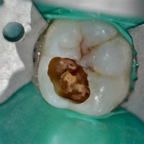 Predictable management of deep carious lesion with bioactive restorative materials. Jacobsen Dental