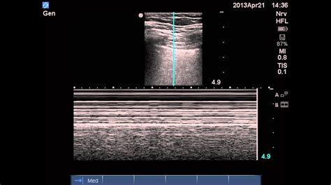 ultrasound diagnosis of pneumothorax - YouTube