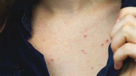 What Are Sweat Pimples And How Do You Treat Them?