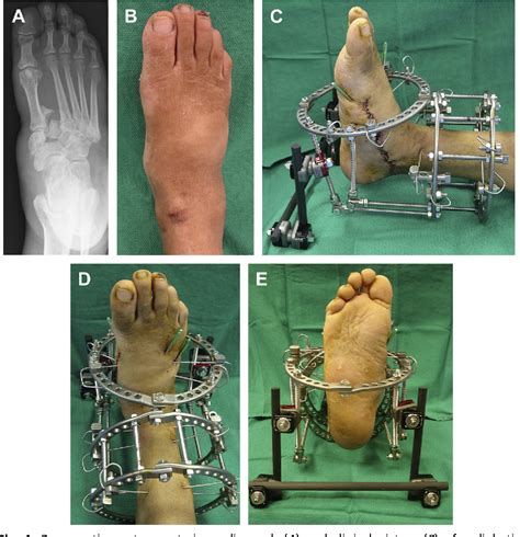 Circular External Fixation as a Primary or Adjunctive Therapy for the ...