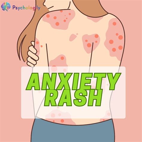 Anxiety Rash: Understanding the Link Between Stress and Skin Irritation - Psychologily