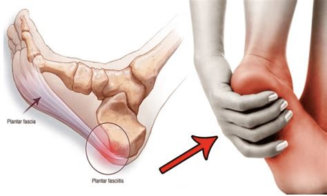 Plantar Fasciitis: Treatment options for your painful heel(s ...