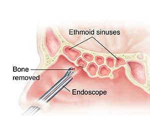 Endoscopic Sinus Surgery | Saint Luke's Health System