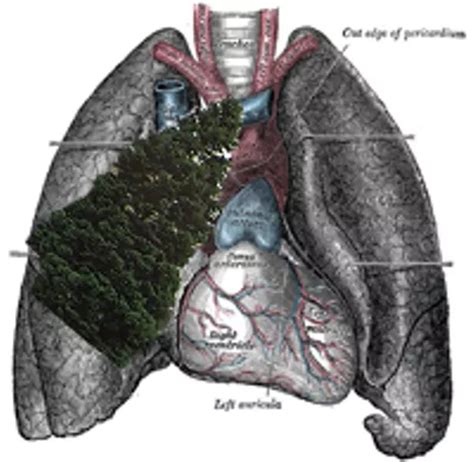 Tree In Lung / Tree Lung Veins River Wiolo Com - Thus, the bronchioles resemble a branching or ...